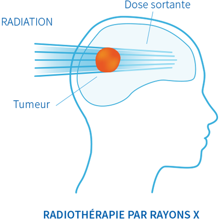 radiotherapie-par-rayons-protontherapie-normandie